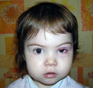 Як і чим лікувати ячмінь під оком і всередині його