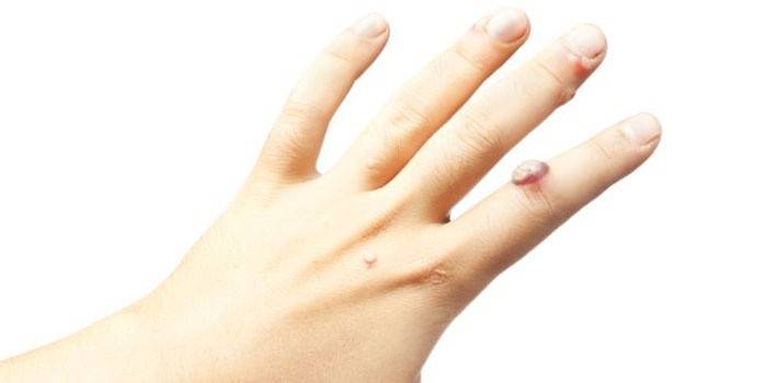 Як лікувати бородавки на пальцях рук