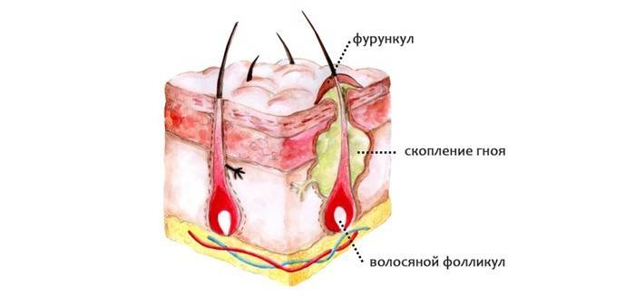 Як позбутися від фурункулів в домашніх умовах