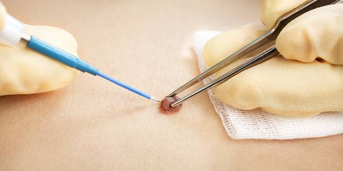 Як позбутися від папілом в домашніх умовах