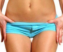 Як позбутися від розтяжок: поради, домашні рецепти