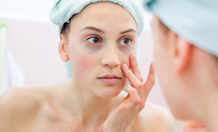 Як прибрати набряки і мішки під очима: поради. Чому з'являються набряки і мішки під очима: причини