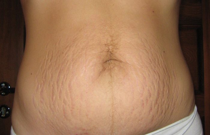 Як прибрати розтяжки після пологів? Догляд за шкірою після пологів