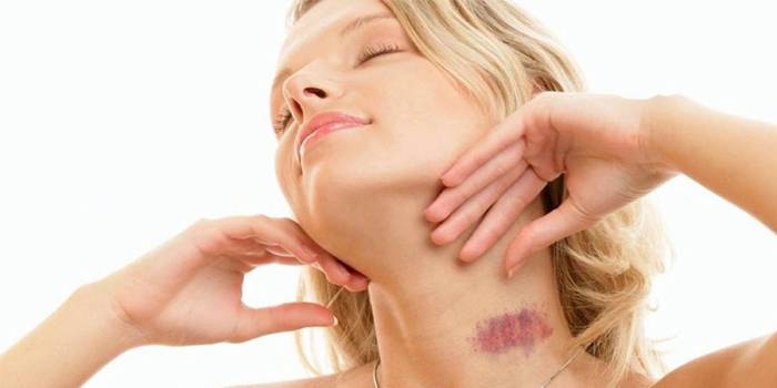 Як швидко позбавитися від засоса в домашніх умовах