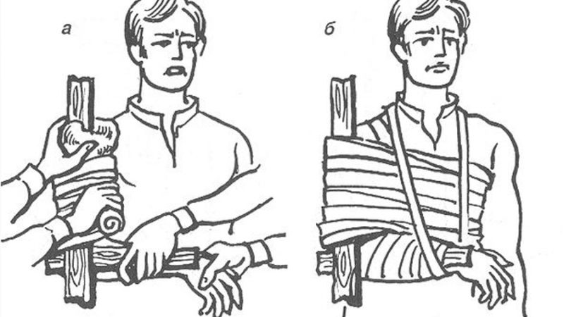 Які суглоби повинна фіксувати шина при переломі? Як накладати шини при переломі стегна, плеча, передпліччя, гомілки?