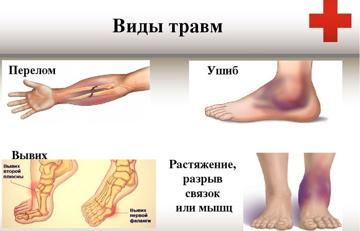 Як відрізнити забій від перелому, тріщини: ознаки, порівняння. Може бути перелом без болю?