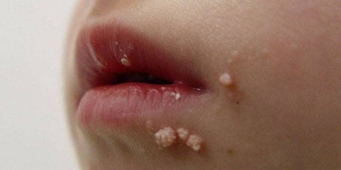 Як вивести бородавки на обличчі в домашніх умовах