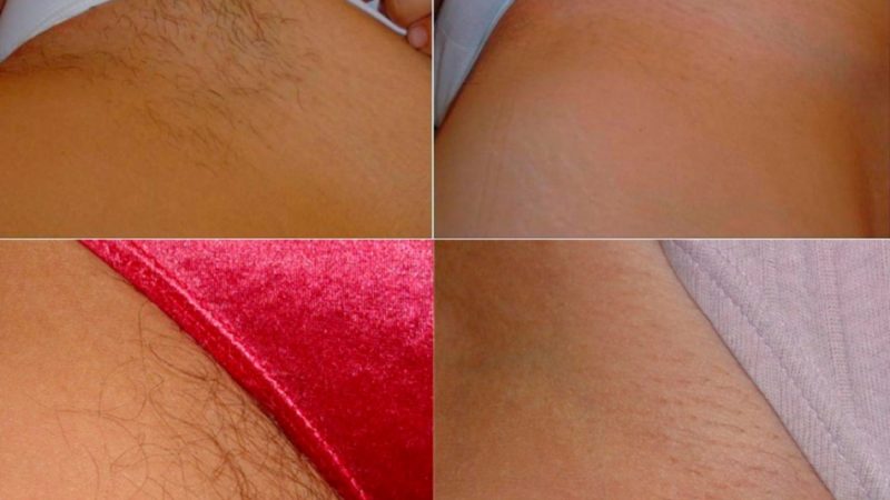 Як зробити шугарінг зони глибокого бікіні самій собі? Інструкція з приготування цукрової пасти