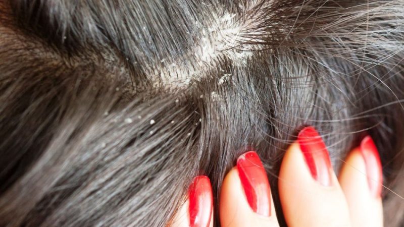 Який засіб від лупи найефективніше? Засоби проти лупи: список. Народні рецепти і аптечні препарати від лупи