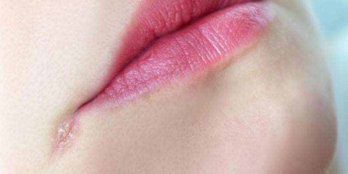 Заїди в куточках рота — причини і лікування в домашніх умовах